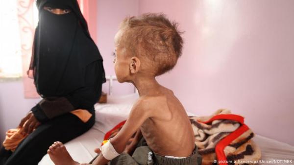 فساد منظمات الإغاثة الدولية يفاقم أزمة الجوع في اليمن